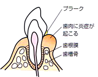 プラーク1