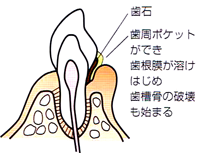プラーク2