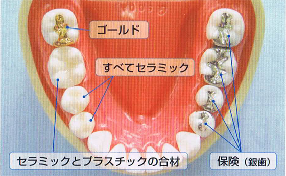 詰め物